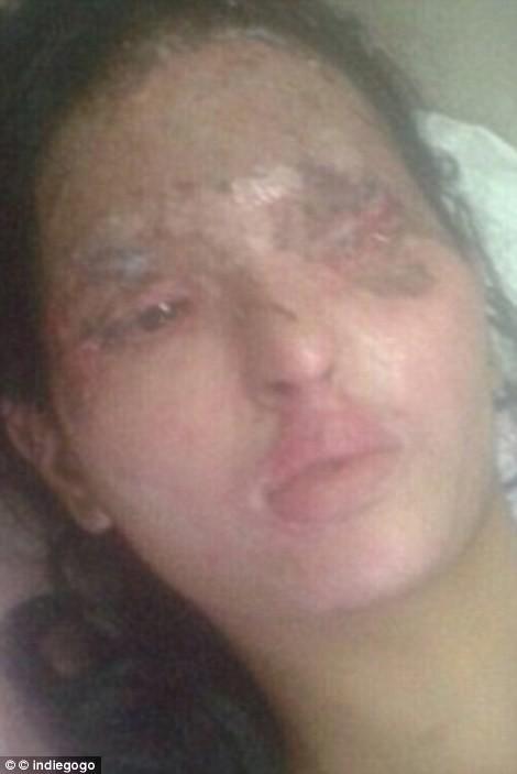 Индийская модель, изуродованная кислотой, вышла на подиум в Нью-Йорке