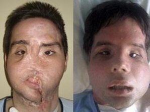 Человек с полной трансплантацией лица появился на публике