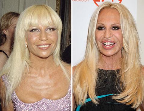 Самые известные жертвы пластической хирургии