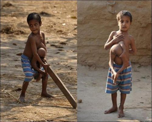 Врачи прооперировали мальчика-осьминога из Непала