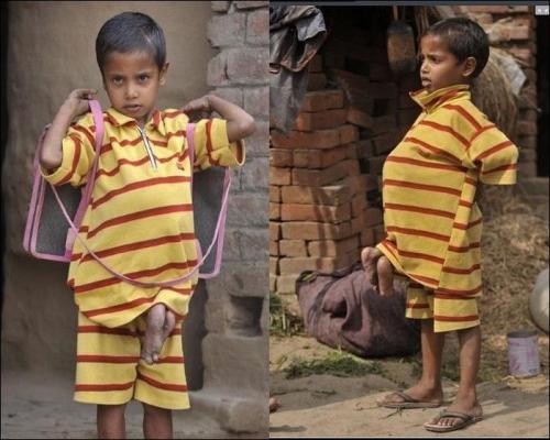 Врачи прооперировали мальчика-осьминога из Непала