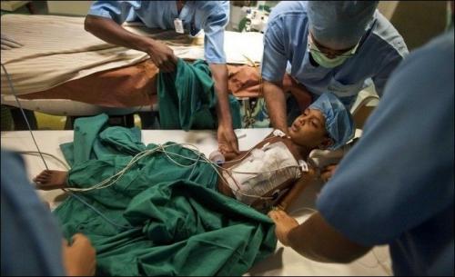 Врачи прооперировали мальчика-осьминога из Непала
