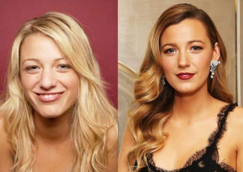 Звезды, которым пластика пошла на пользу