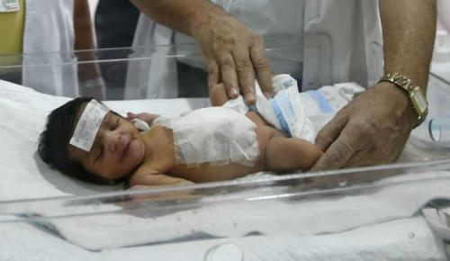 Хирурги отрезали выросшую на животе новорожденной голову