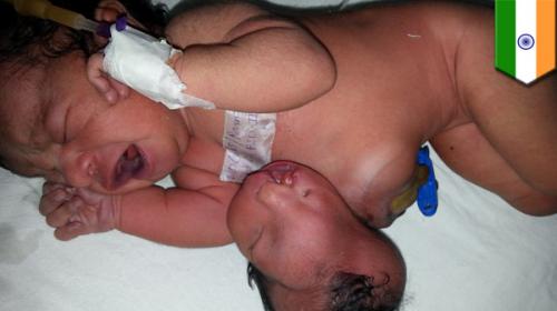 Хирурги отрезали выросшую на животе новорожденной голову