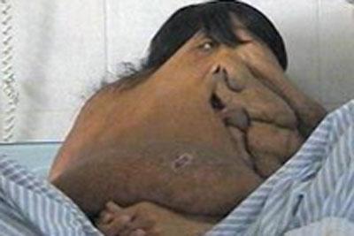 Опухоль на лице мужчины достигла веса в 15 килограмм