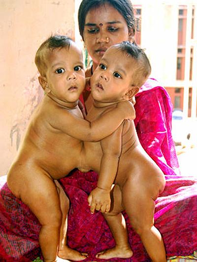 Сиамские близнецы: одна жизнь на двоих