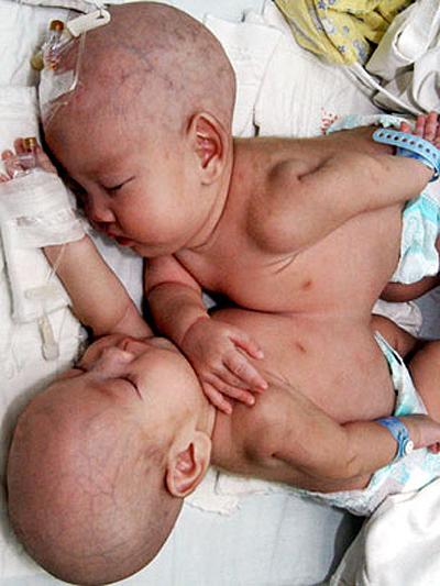 Сиамские близнецы: одна жизнь на двоих