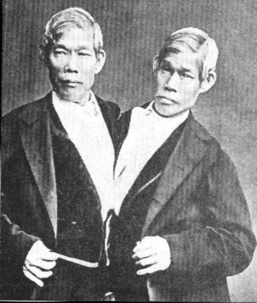 Самые известные сиамские близнецы в мире
