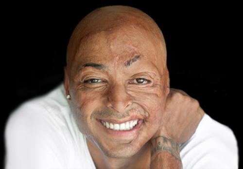 Дефекты и шрамы, которые уродуют голливудских звезд