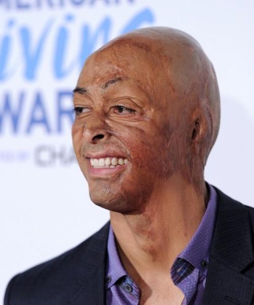 Дефекты и шрамы, которые уродуют голливудских звезд