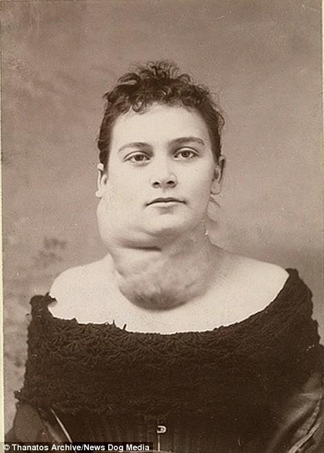 Шокирующая коллекция архивных фото людей с деформациями тела