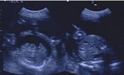 15 самых удивительных случаев исцеления в медицине