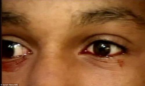 Тинейджер плачет кровавыми слезами