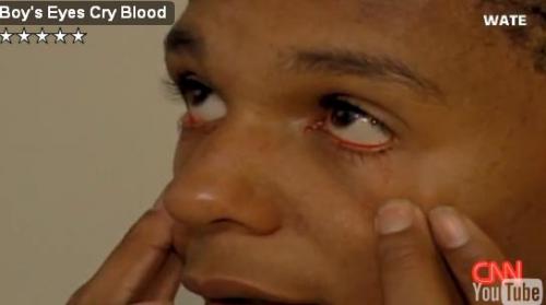 Тинейджер плачет кровавыми слезами