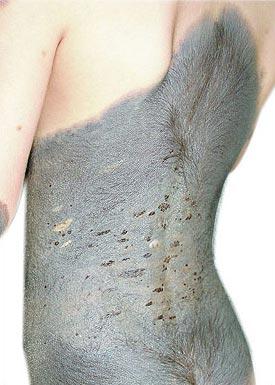 У китайского мальчика на спине вырос мех