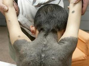 У китайского мальчика на спине вырос мех