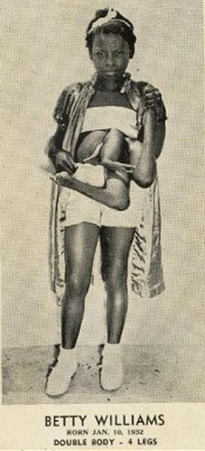 "Короли уродства": трёх, четырёх и… пятиногие люди