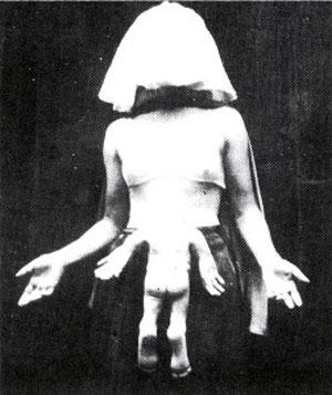 "Короли уродства": трёх, четырёх и… пятиногие люди