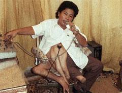 "Короли уродства": трёх, четырёх и… пятиногие люди