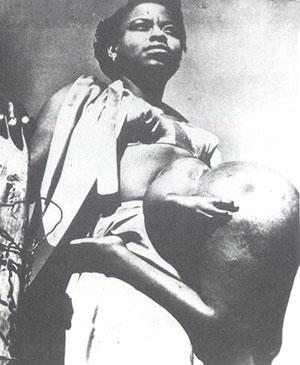 "Короли уродства": трёх, четырёх и… пятиногие люди