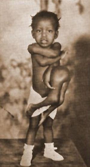 "Короли уродства": трёх, четырёх и… пятиногие люди