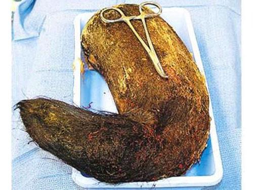 Шокирующие предметы, найденные в человеческих желудках