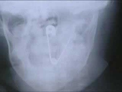 Шокирующие предметы, найденные в человеческих желудках