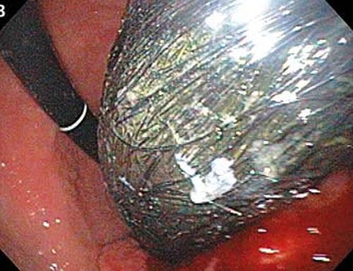 Шокирующие предметы, найденные в человеческих желудках