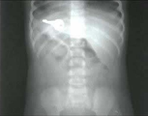 Шокирующие предметы, найденные в человеческих желудках