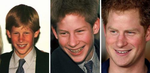 14 звезд до, во время и после брекетов