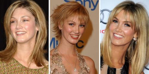 14 звезд до, во время и после брекетов