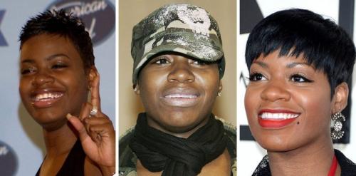 14 звезд до, во время и после брекетов