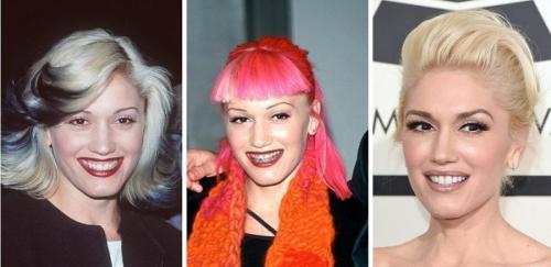 14 звезд до, во время и после брекетов