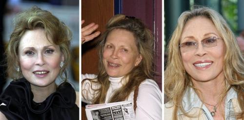 14 звезд до, во время и после брекетов