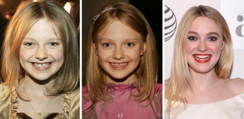 14 звезд до, во время и после брекетов