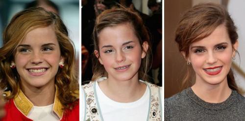 14 звезд до, во время и после брекетов