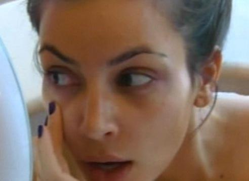 Ким Кардашьян неудачно вколола ботокс