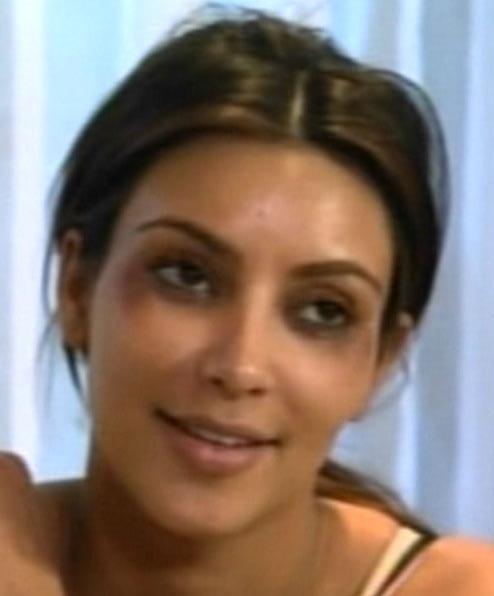 Ким Кардашьян неудачно вколола ботокс