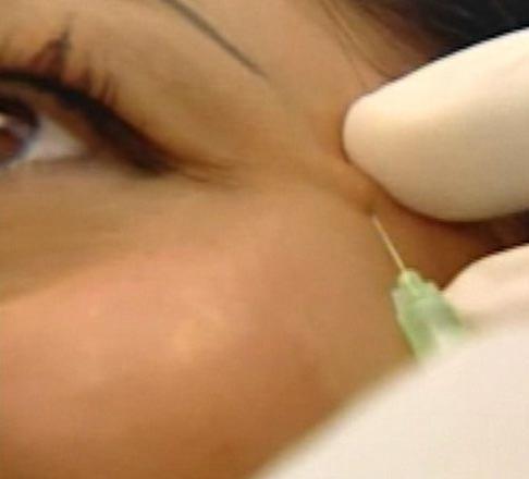 Ким Кардашьян неудачно вколола ботокс