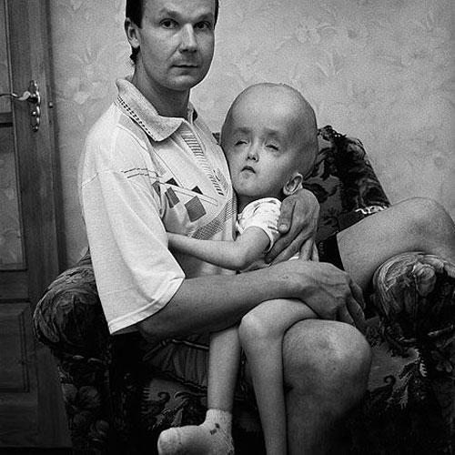 Люди, пострадавшие от "мирного атома"