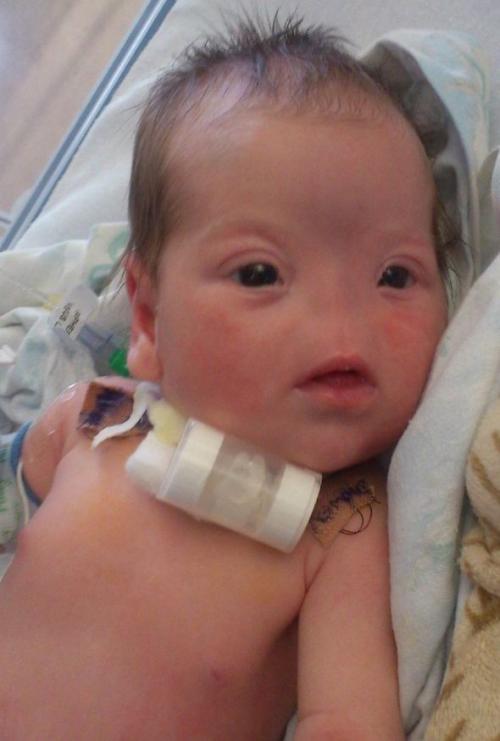 Девочку без носа ждет операция в Лондоне