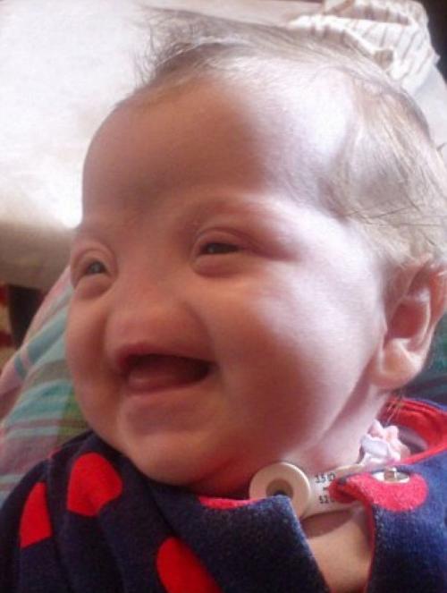 Девочку без носа ждет операция в Лондоне