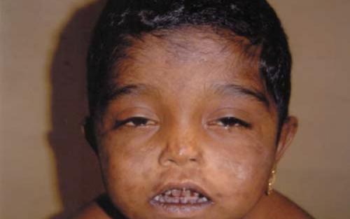 Самые странные и необъяснимые болезни в мире