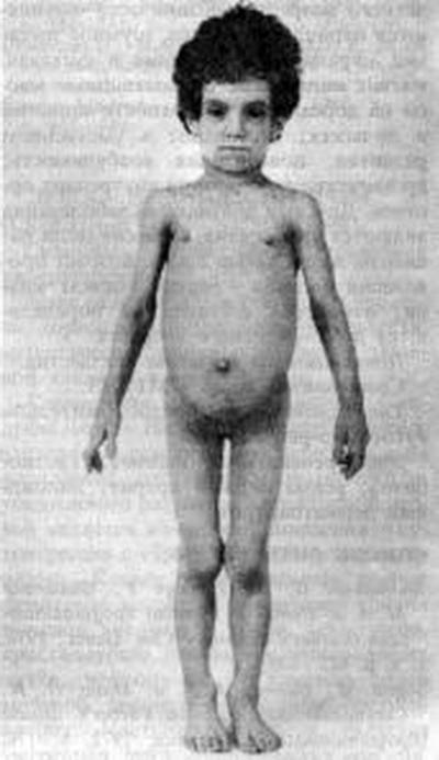 Самые странные и необъяснимые болезни в мире