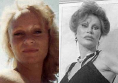 Самые известные жертвы пластической хирургии