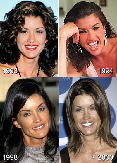 Самые известные жертвы пластической хирургии