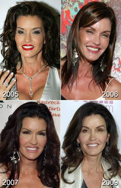 Самые известные жертвы пластической хирургии