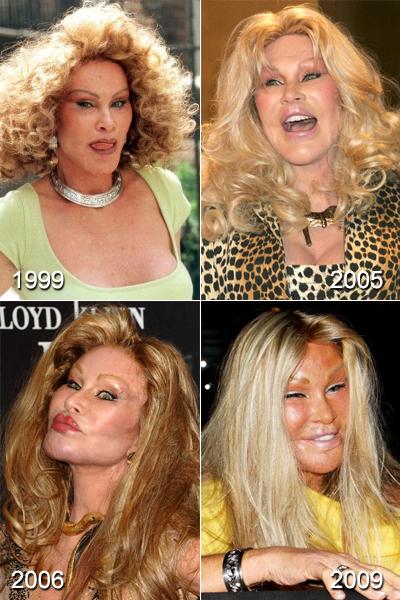 Самые известные жертвы пластической хирургии