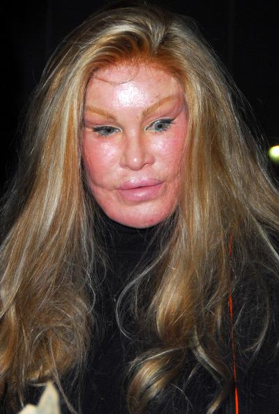 Самые известные жертвы пластической хирургии